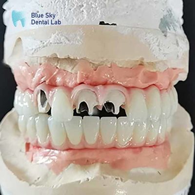 comprar Puente de titanio Malo Puente de implante sin abutment de múltiples unidades Cementable online manufacture