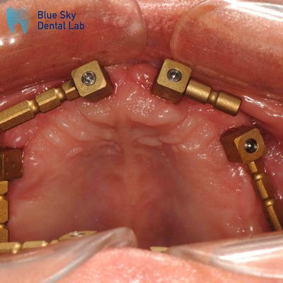 comprar Oro Titanio Cuerpo de escaneo de unidad múltiple Sistema CAM Cuerpo de escaneo dental online manufacture