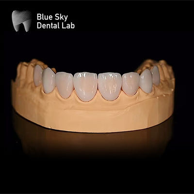 comprar Casos de carilla dental rectangular ligeros con ajuste pasivo Solo 0.3 mm online manufacture