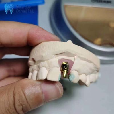 comprar Casos de implantes regulares con implante dental individual personalizable Casos de implantes de arco desplazado online manufacture