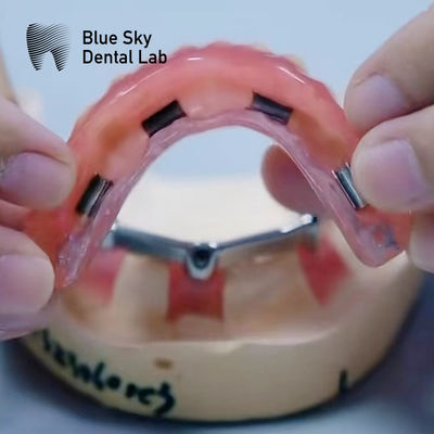 comprar Dentadura dental de acrílico barra de titanio con accesorios de plata y oro online manufacture