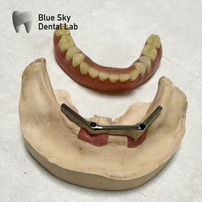 comprar Implante Dental con prótesis extraíble online manufacture