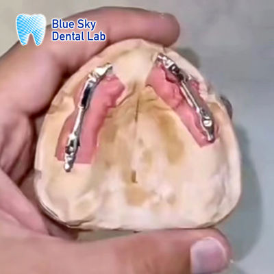 comprar Implante Dental Removible de Barras de Titanio Segmentación Implante de Cielo Azul online manufacture