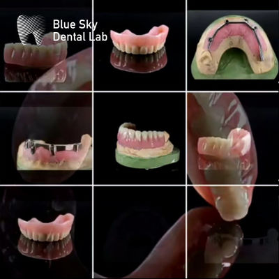 comprar Barras de titanio con dentadura acrílica online manufacture