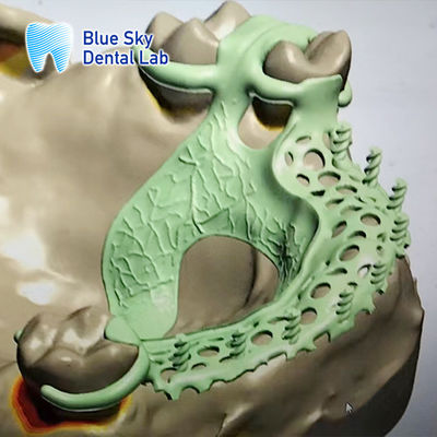comprar Diseño del marco de la dentadura extraíble Rpd Diseño del marco de la dentadura parcial metálica online manufacture