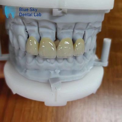 Coroa de zirconia de varias capas de zirconia de porcelana