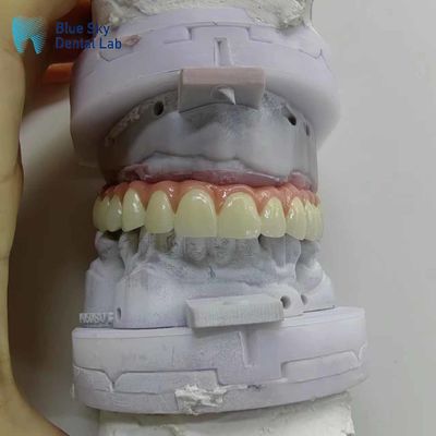Casos de implantes dentales artificiales de la naturaleza Casos de implantes bucales personalizados