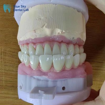 Implantes dentales artificiales de arco completo Casos de operación para procedimientos quirúrgicos