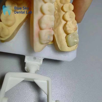 Coronas de zircónia resistentes a la corrosión con aspecto natural Dientes de zircónia
