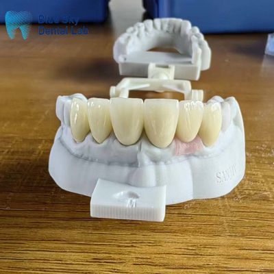 Coronas de zirconia de capas altamente translúcidas naturales con corona de implante