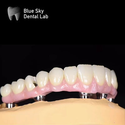Blue Sky Naturaleza Implante Dental Cuadro de Implante de Múltiples Opciones Sistema