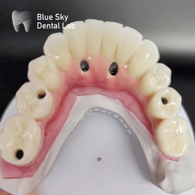 Casos de implantes dentales de arco completo compatibles con sistemas de implantes múltiples