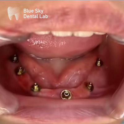 Diseño de la naturaleza caso de implante dental caso de operación de implantes para múltiples opciones