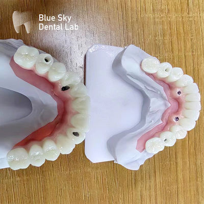 Casos para implantes dentales múltiples Casos de procedimiento de implantes personalizados