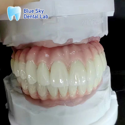 Casos de implantes dentales regulares Naturaleza y durabilidad para equipos médicos