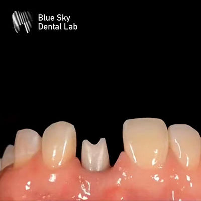 Implantes dentales hipoalergénicos de zirconia con abutución biocompatible