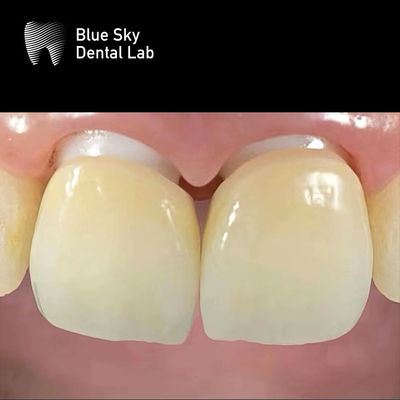 Implante de zirconia en capas Corona de zirconia Abutment Biocompatible