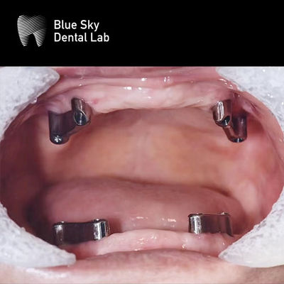 Sistema de implantes dentales con barra de titanio removible