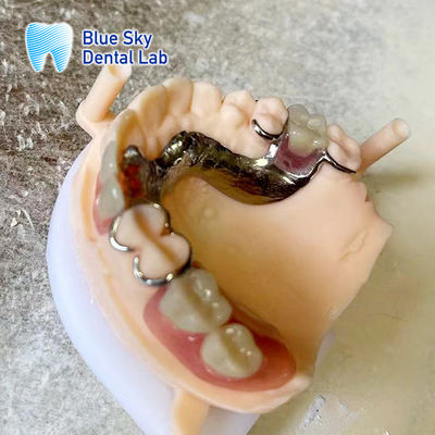 Dentadura parcial de resina acrílica ligera con marco de metal Dentaduras de aspecto realista