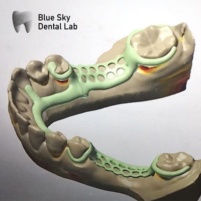 Diseño del marco de la dentadura parcial removible