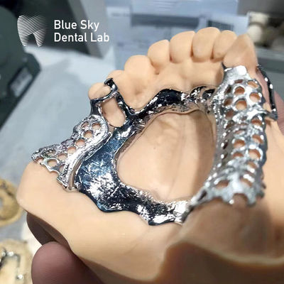 Cuadro Dental de Cielo Azul Dentadura Maxilar Parcial Cuadro de Metal Fundido