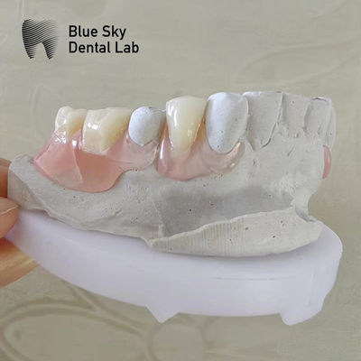 Sonrisa natural Dental Valplast Dentaduras flexibles Valplast Dentadura parcial extraíble