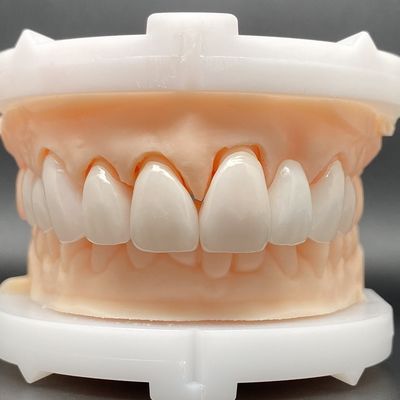 Casos de chapa EMax con ajuste pasivo en varios colores, hacen una sonrisa hermosa con una preparación mínima de los dientes